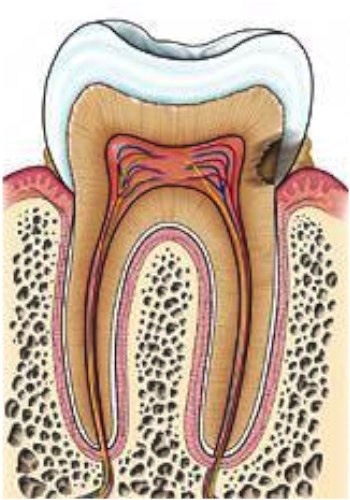 caries dentaires 1